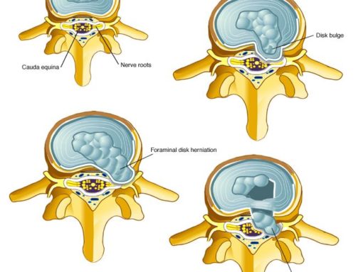 Making Sense of the Lumbar Disc!